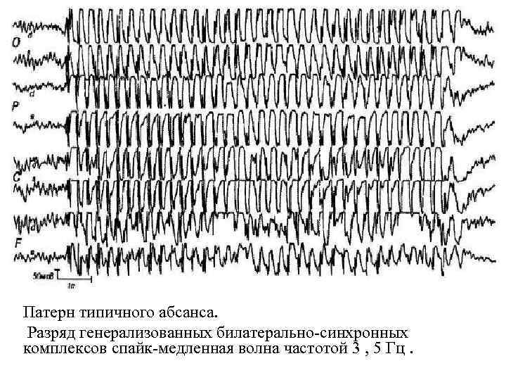 Патерн типичного абсанса. Разряд генерализованных билатерально-синхронных комплексов спайк-медленная волна частотой 3 , 5 Гц.