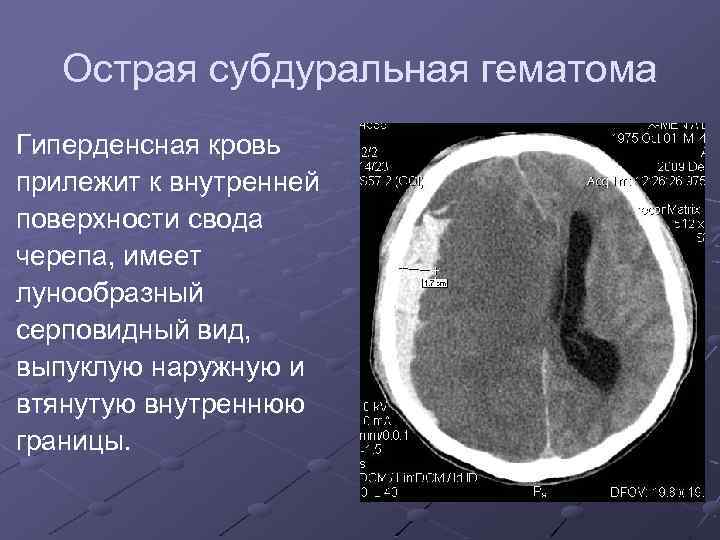 Острая субдуральная гематома Гиперденсная кровь прилежит к внутренней поверхности свода черепа, имеет лунообразный серповидный