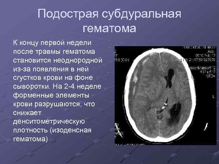 Подострая субдуральная гематома К концу первой недели после травмы гематома становится неоднородной из-за появления