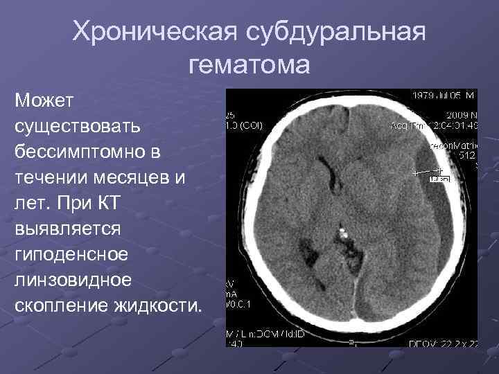 Хроническая субдуральная гематома Может существовать бессимптомно в течении месяцев и лет. При КТ выявляется