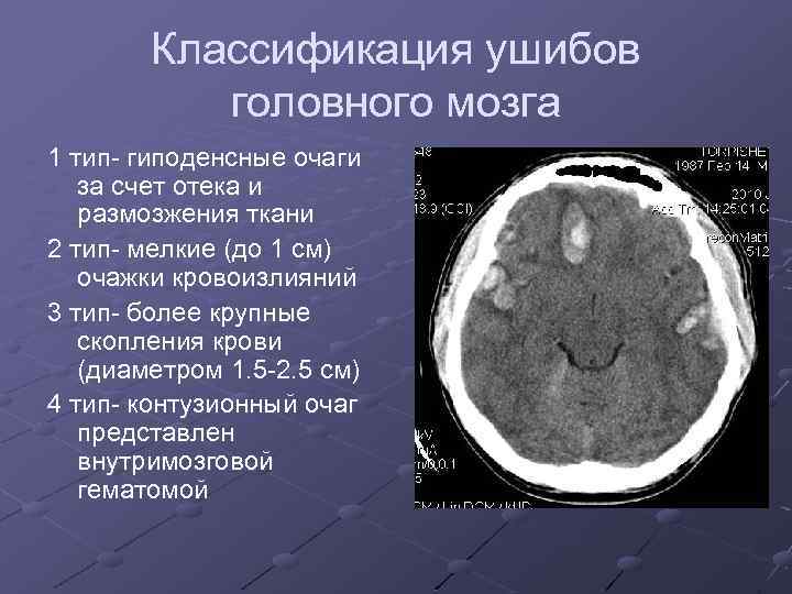 Классификация ушибов головного мозга 1 тип- гиподенсные очаги за счет отека и размозжения ткани