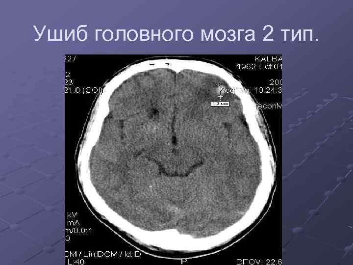 Ушиб головного мозга 2 тип. 