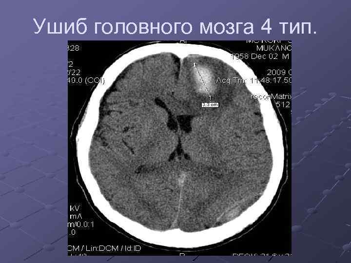 Ушиб головного мозга 4 тип. 