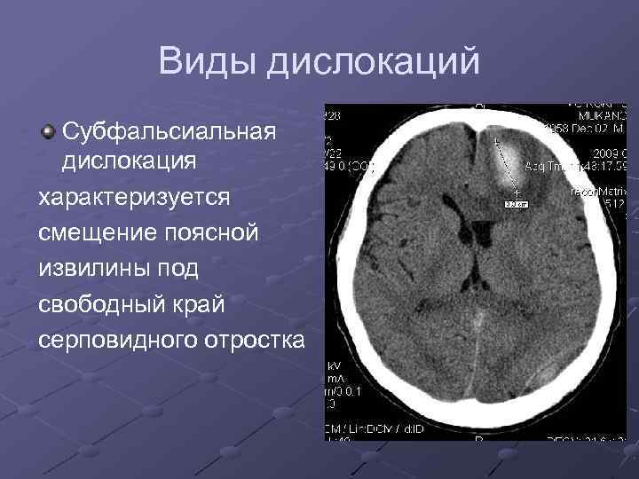 Виды дислокаций Субфальсиальная дислокация характеризуется смещение поясной извилины под свободный край серповидного отростка 