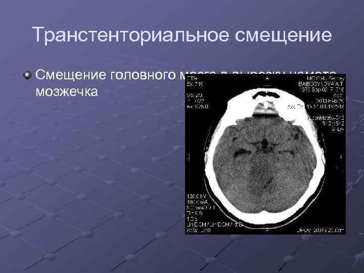 Транстенториальное смещение Смещение головного мозга в вырезку намета мозжечка 