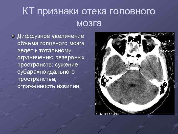 КТ признаки отека головного мозга Диффузное увеличение объема головного мозга ведет к тотальному ограничению