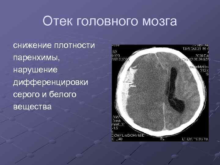 Отек головного мозга снижение плотности паренхимы, нарушение дифференцировки серого и белого вещества 