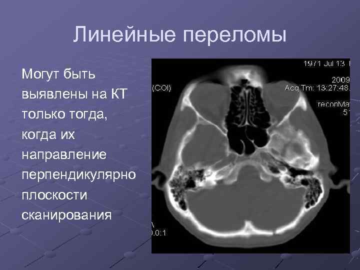 Линейные переломы Могут быть выявлены на КТ только тогда, когда их направление перпендикулярно плоскости