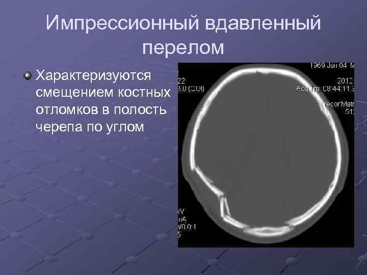 Импрессионный вдавленный перелом Характеризуются смещением костных отломков в полость черепа по углом 