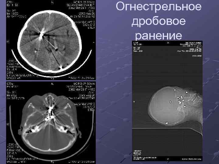 Огнестрельное дробовое ранение 