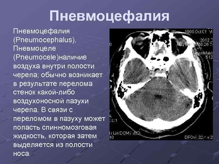 Пневмоцефалия (Pneumocephalus), Пневмоцеле (Pneumocele)наличие воздуха внутри полости черепа; обычно возникает в результате перелома стенок