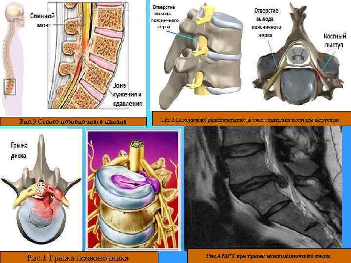 Рис. 3 Стеноз позвоночного канала Рис. 1 Грыжа позвоночника Рис. 2 Поясничная радикулопатия за