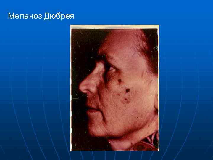 Меланоз Дюбрея 