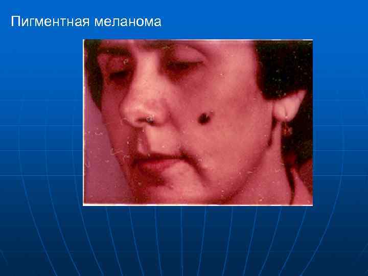 Пигментная меланома 