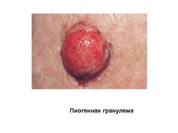 Пиогенная гранулема 