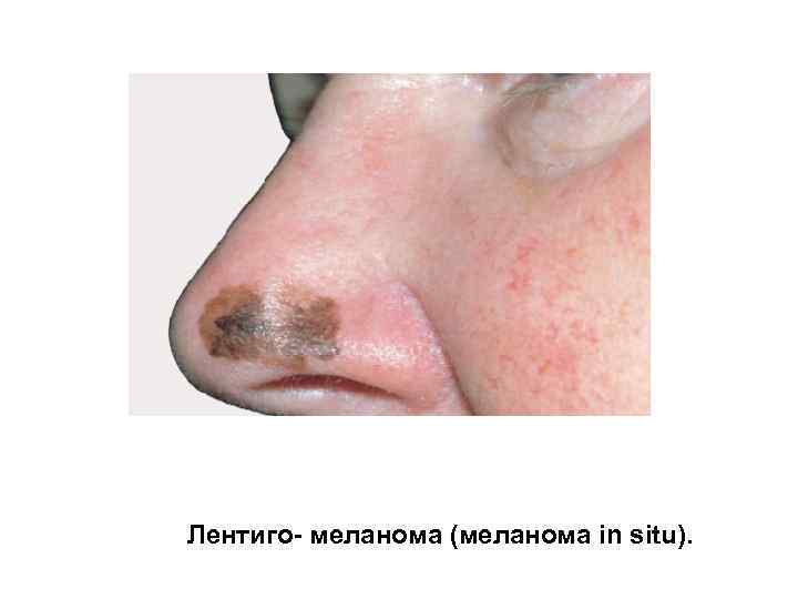 Лентиго- меланома (меланома in situ). 