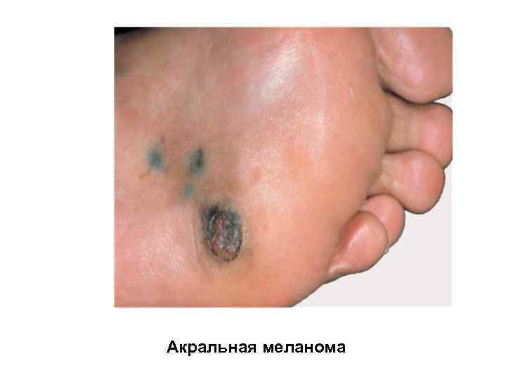 Акральная меланома 