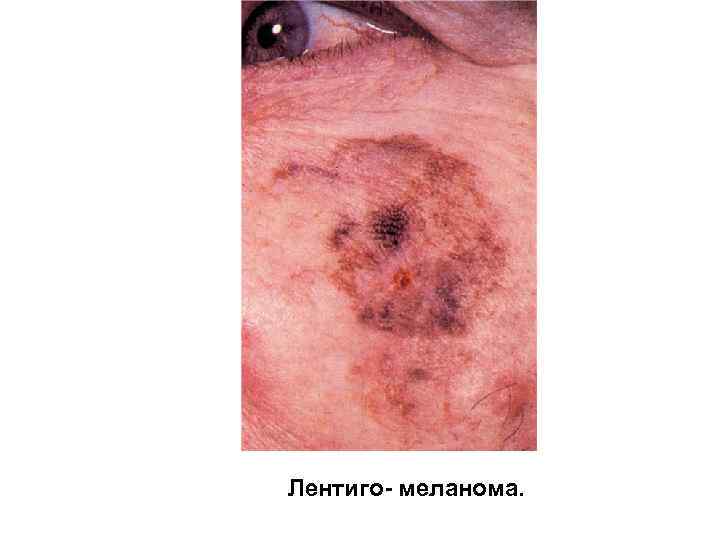 Лентиго- меланома. 