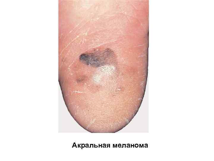 Акральная меланома 