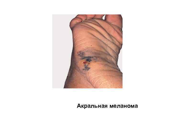 Акральная меланома 