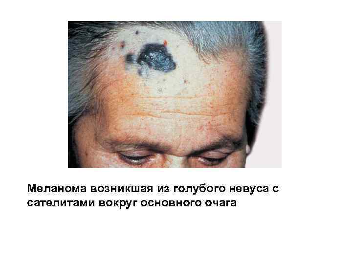Меланома возникшая из голубого невуса с сателитами вокруг основного очага 