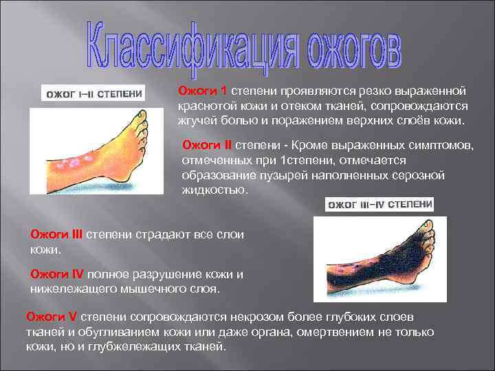 Клинические проявления ожогов 1 степени. Ожоги 1 степень 2 степень 3 степень 4 степень.