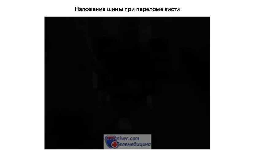 Наложение шины при переломе кисти 