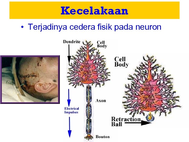 Kecelakaan • Terjadinya cedera fisik pada neuron 