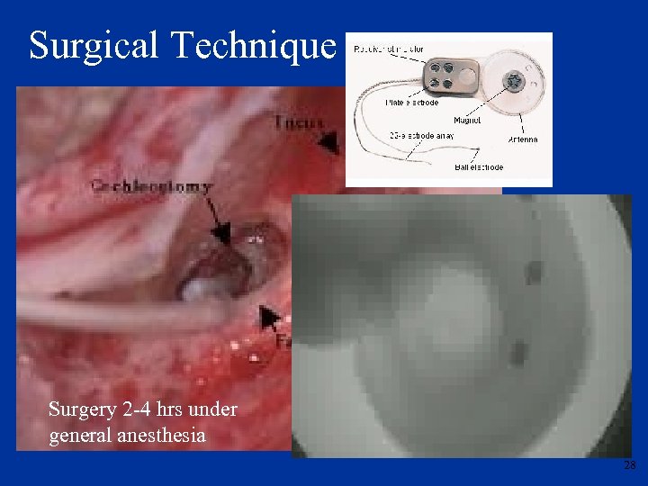 Surgical Technique Surgery 2 -4 hrs under general anesthesia 28 