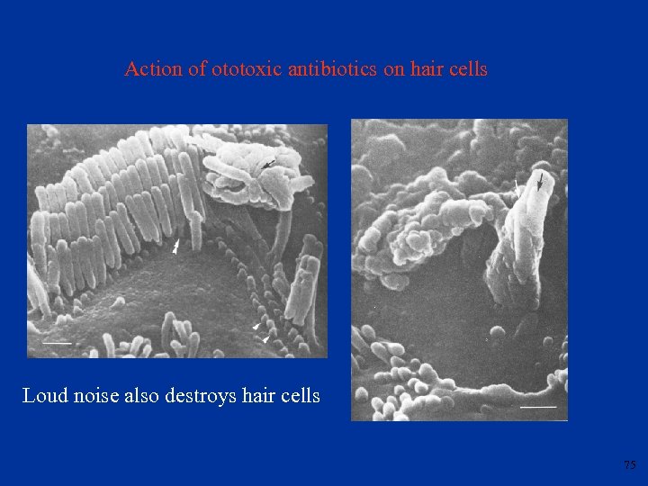 Action of ototoxic antibiotics on hair cells Loud noise also destroys hair cells 75