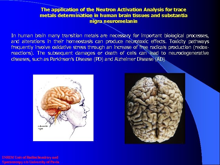 The application of the Neutron Activation Analysis for trace metals determination in human brain