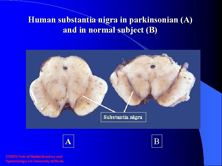 Human substantia nigra in parkinsonian (A) and in normal subject (B) A INRIM Unit