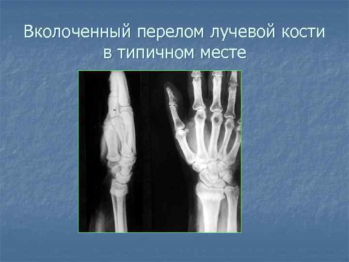 Вколоченный перелом лучевой кости в типичном месте 