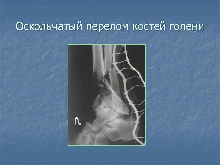 Оскольчатый перелом костей голени 
