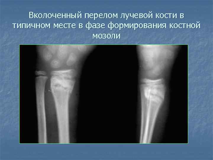 Вколоченный перелом лучевой кости в типичном месте в фазе формирования костной мозоли 