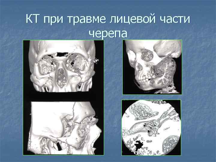 КТ при травме лицевой части черепа 