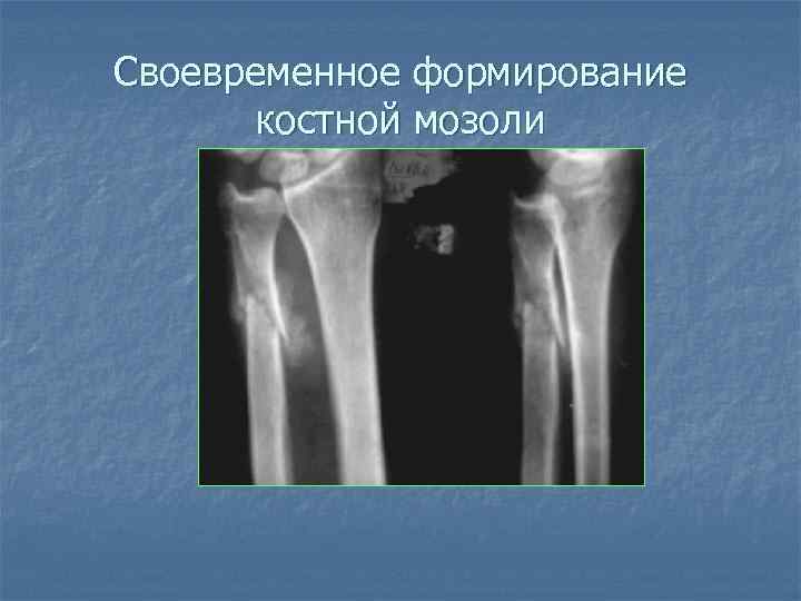 Своевременное формирование костной мозоли 