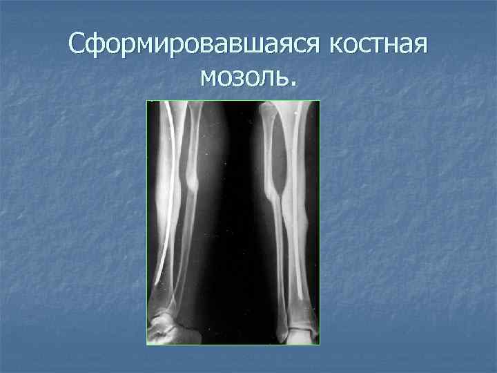 Сформировавшаяся костная мозоль. 