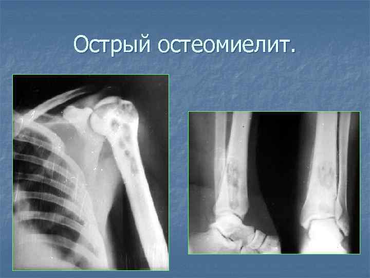 Острый остеомиелит. 