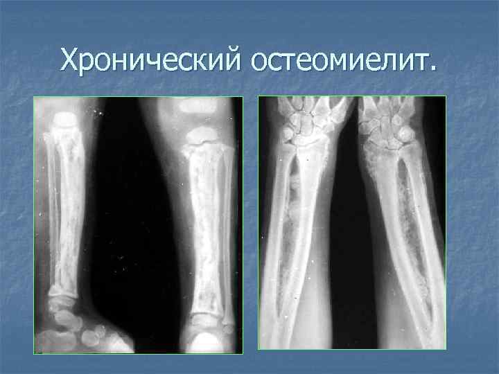 Хронический остеомиелит. 