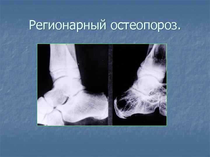 Регионарный остеопороз. 