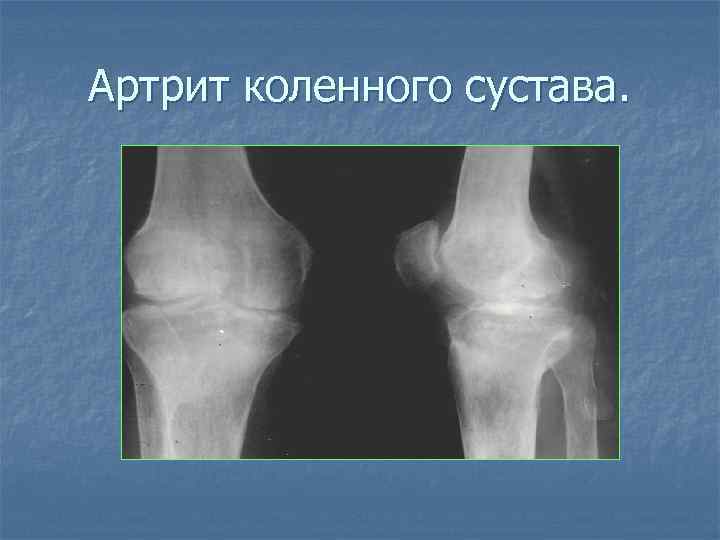 Артрит коленного сустава. 