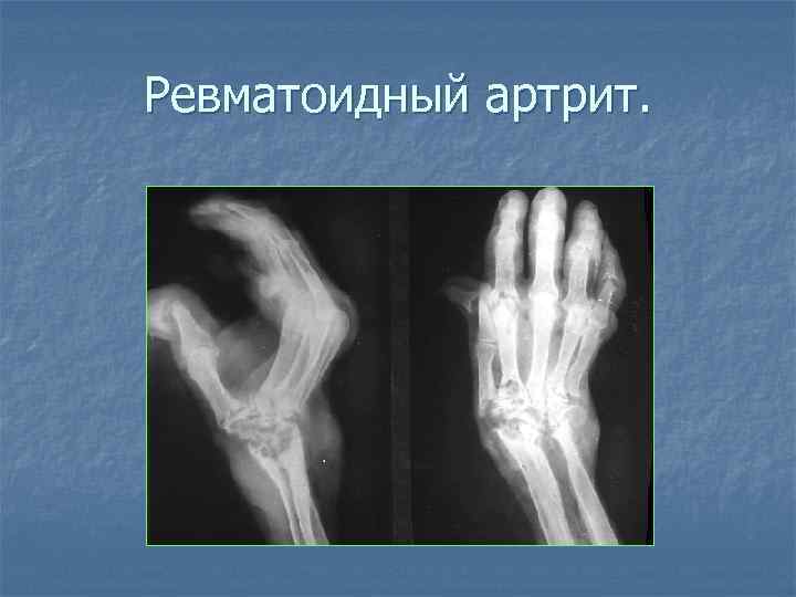 Ревматоидный артрит. 