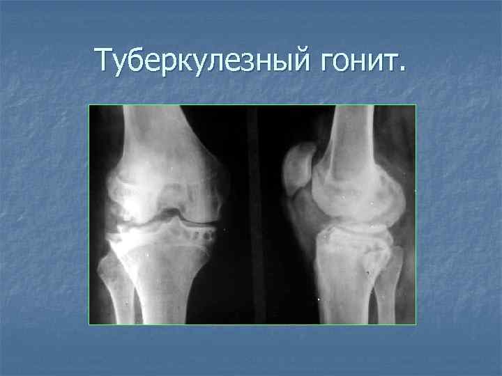 Туберкулезный гонит. 