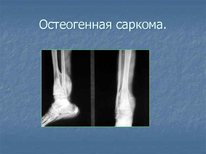 Остеогенная саркома. 
