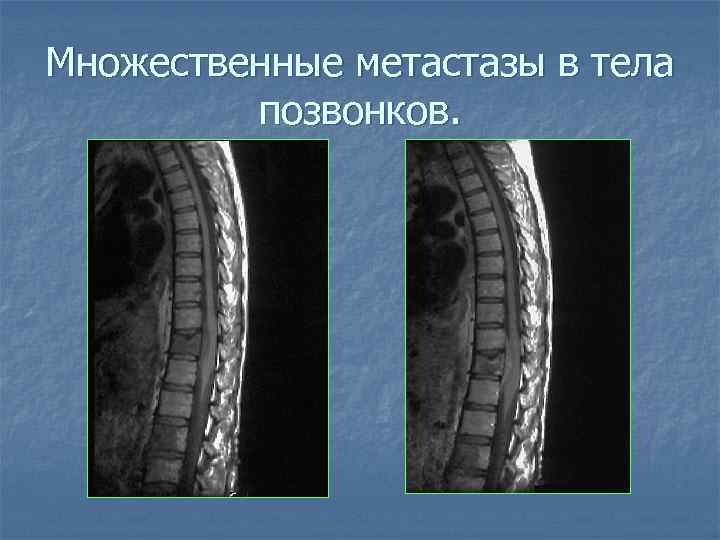 Множественные метастазы в тела позвонков. 