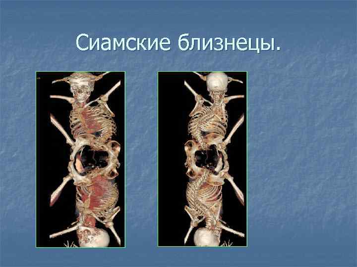 Сиамские близнецы. 