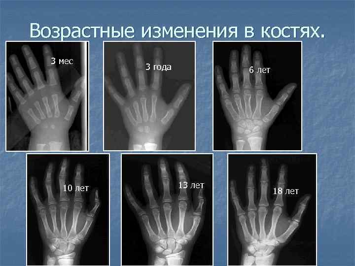 Возрастные изменения в костях. 3 мес 10 лет 3 года 6 лет 13 лет