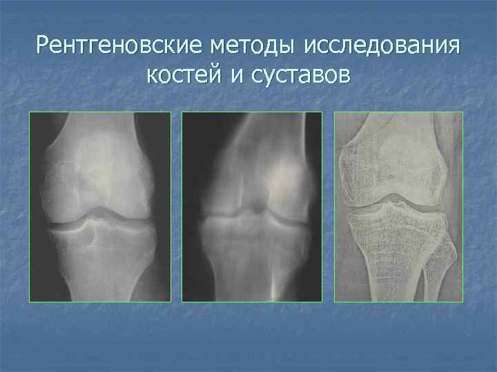 Рентгеновские методы исследования костей и суставов 
