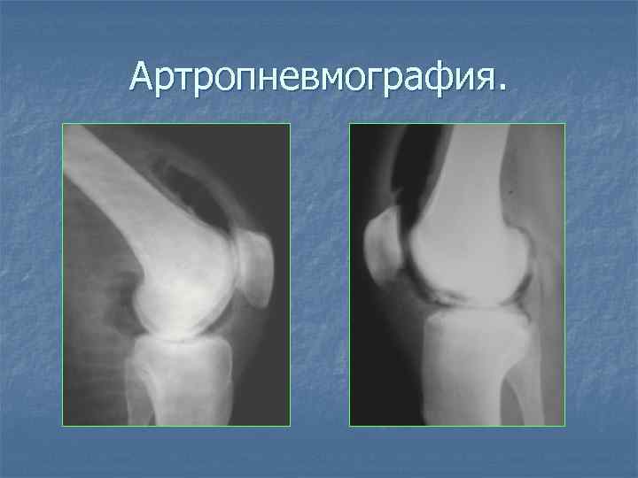 Артропневмография. 